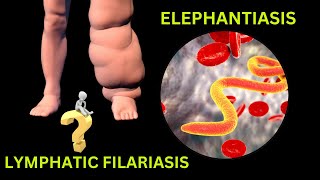 Lymphatic Filariasis Elephantiasis Causes Life Cycle and Treatment elephantiasis filariasis [upl. by Janeen46]