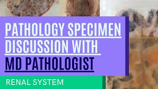 Pathology Specimen Discussion with MD Pathologist  Renal System [upl. by Mohammed]