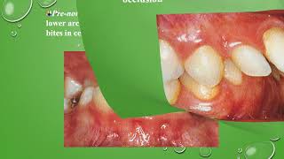 MalOcclusion Lecture Three مل اکلوژن جلسه سوم [upl. by Jaine]