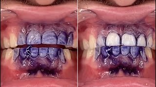 V34 Mousse Teeth Whitening Purple Toothpaste Review  hismile toothpaste [upl. by Akirdnas873]