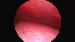 Thoracoscopy  Malignant Pleural Effusion  Lymphoma  Cancer [upl. by Yendic]