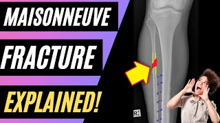 What is a MAISONNEUVE FRACTURE [upl. by Maynard]