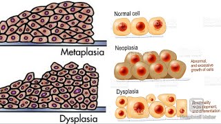 Metaplasia and dysplasia 😀 [upl. by Alton390]