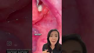 Tonsil Stones and how to avoid them [upl. by Euk595]