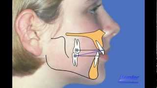 Correcting overbiteoverjet [upl. by Meehan]