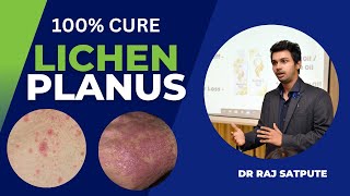 Lichen Planus Pigmentosus  ONLY CURE IN AYURVEDA 100 Lichen Planus Treatment [upl. by Ronni]