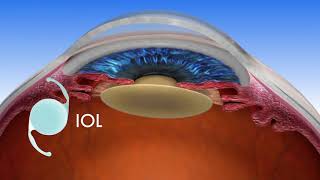 Femtosecond laser assisted cataract surgery FLACS by Prof Menapace [upl. by Symon]