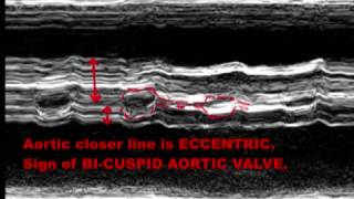 BICUSPID AORTIC VALVE  ECHOCARDIOGRAPHY SERIES BY DR ANKUR K CHAUDHARI [upl. by Hallie]