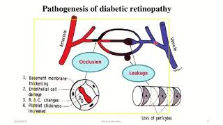 pathogenesis of Diabetic Retinopathy [upl. by Merrielle511]