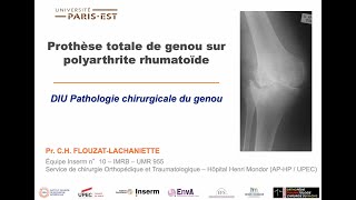 12  PTG sur polyarthrite rhumatoïde [upl. by Oirasan]