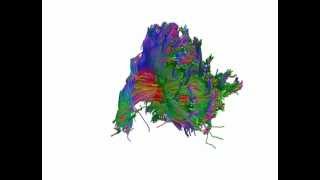 DTI 3D Tractography of the Corpus Callosum [upl. by Tessa]