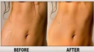 REVITOL STRETCH MARK CREAM BEFORE AND AFTER PICTURES [upl. by Hsima654]