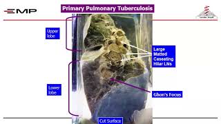 Infectious module pathology Tuberculosis  sarcoidosis  granuloma  part 2 [upl. by Axia]