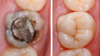 DRendo  Complex rehabilitation of a severely broken down maxillary molar maintaining pulp vitality [upl. by Brenk439]