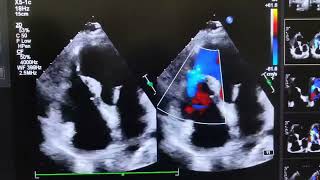 VENTRICULAR SEPTAL REPTUREVSR [upl. by Akinat]