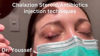 NEW treatment for stye  hordeolum  chalazion [upl. by Starla307]