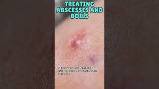 Treating Abscesses and Boils  Your Essential Guide to Skin Infections in the Wild [upl. by Ailido]