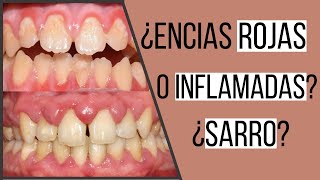 Gingivitis  encías inflamadas  Odontologia Con Cri [upl. by Nnaecarg484]