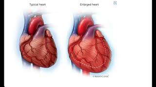 Cardiomegaly Video Lecture [upl. by Alyks]