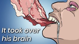 A Man Ate Undercooked Pork This Is What Doctors Found Inside His Brain [upl. by Noraed]