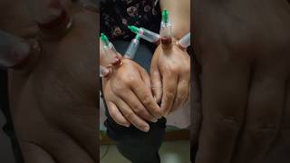 Wet Cupping 🔥cupping cuppingtherapy health reelspain [upl. by Jelsma]