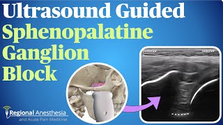 Ultrasound Guided Sphenopalatine Ganglion Block [upl. by Bertasi]