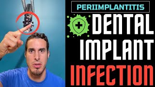 If you wear DENTAL IMPLANTS you should WATCH THIS  Dental Implant INFECTION or PERIIMPLANTITIS [upl. by Anatlus]