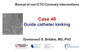 Case 49 PCI Manual  Guide catheter kinking [upl. by Mcgregor]