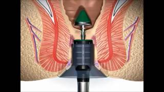 Stapled Haemorrhoidectomy using the PPH System  English [upl. by Ventre]