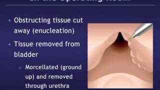 Holmium Laser Enucleation of the Prostate HoLEP for Benign Prostatic Hyperplasia BPH [upl. by Galan648]