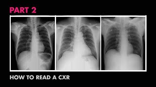 ABCs of Reading a Chest Xray  How to Read a Chest XRay Part 2  MEDZCOOL [upl. by Inalaek]