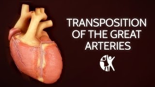 Transposition of the Great Arteries [upl. by Oeramed284]