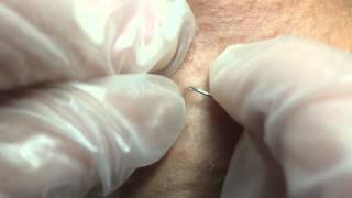 Releasing an Ingrown Hair [upl. by Avuha]