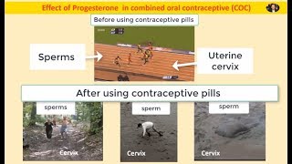 Funny sperm race in the cervix contraceptive progesterone [upl. by Brufsky]