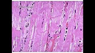 Evolution of a Myocardial Infarction [upl. by Gwennie721]