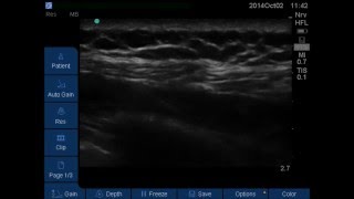 Serratus Plane Block [upl. by Berkshire]