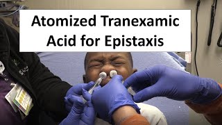 Atomized Tranexamic Acid for Epistaxis Control [upl. by Sheryle261]