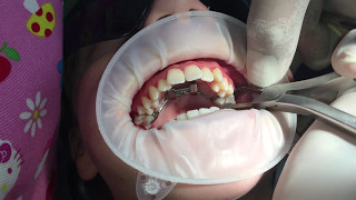 Removal of Rapid Palatal Expansion Appliance [upl. by Netsyrc]