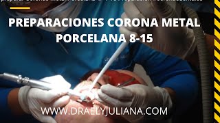 🦷Preparación de Coronas Metal Porcelana👅 815 Colocación de 2do Hilo Retractor [upl. by Alahsal]