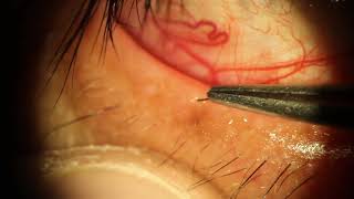 Removing Head Hair Clipping from Inside Eyelid Tear Gland [upl. by Kincaid546]