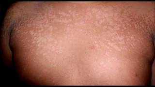 Pityriasis versicolor [upl. by Nospmis]