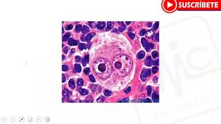 HEMATOLOGÍA Linfoma Hodking y No Hodking  MYC estudios [upl. by Kone]