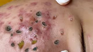 Big Cystic Acne Blackheads Extraction Blackheads amp Milia Whiteheads Removal Pimple Popping [upl. by Aneehsyt]