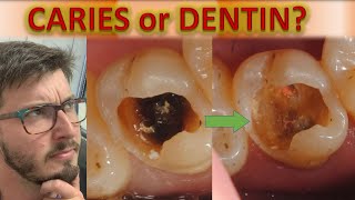 Until Where to Remove Caries on Dentin TUTORIAL Deep Caries Removal How to Radiology Detection [upl. by Otnicaj]