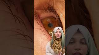 Subconjunctival hemorrhage 👁️👁️youtubeshorts shorts youtubevideos youtube youtube youtube [upl. by Bellaude524]