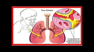 Les meilleurs remèdes naturels contre la toux grasse [upl. by Ettesel]