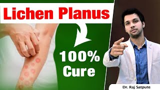 लाइकेन प्लैनस के लिए पांच महत्वपूर्ण विषय  5 Tips For Lichen Planus in Hindi  Lichen Planus Hindi [upl. by Colt351]