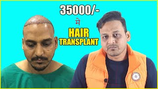 Hair Transplant in India  Youtubers का घोटाला  Hair Transplant Best Result 2024 [upl. by Idel]