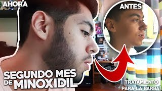 SEGUNDO MES USANDO MINOXIDIL  TRATAMIENTO PARA LA BARBA [upl. by Zap687]