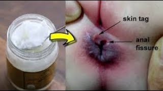 Coconut oil for hemorrhoids treatment at home Fast acting remedy [upl. by Anderegg80]